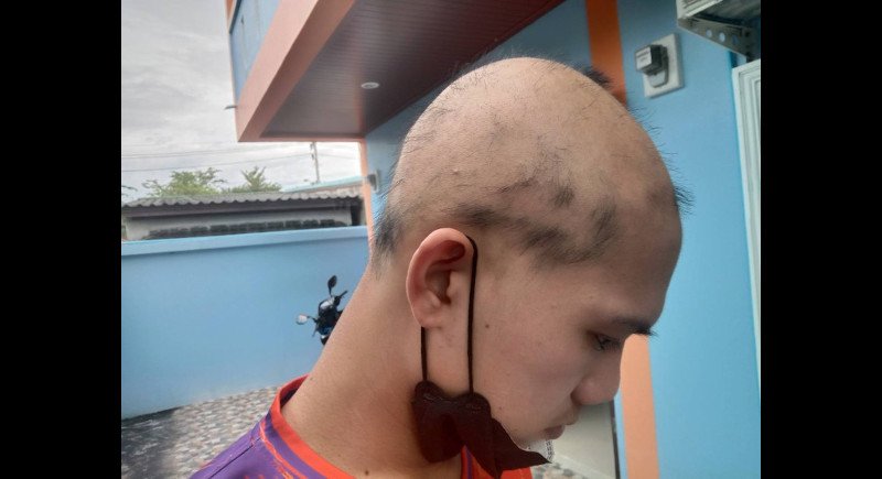 Пхукетский студент заявил, что лишился волос после прививки от COVID-19. Фото: Иккапоп Тхонгтуб