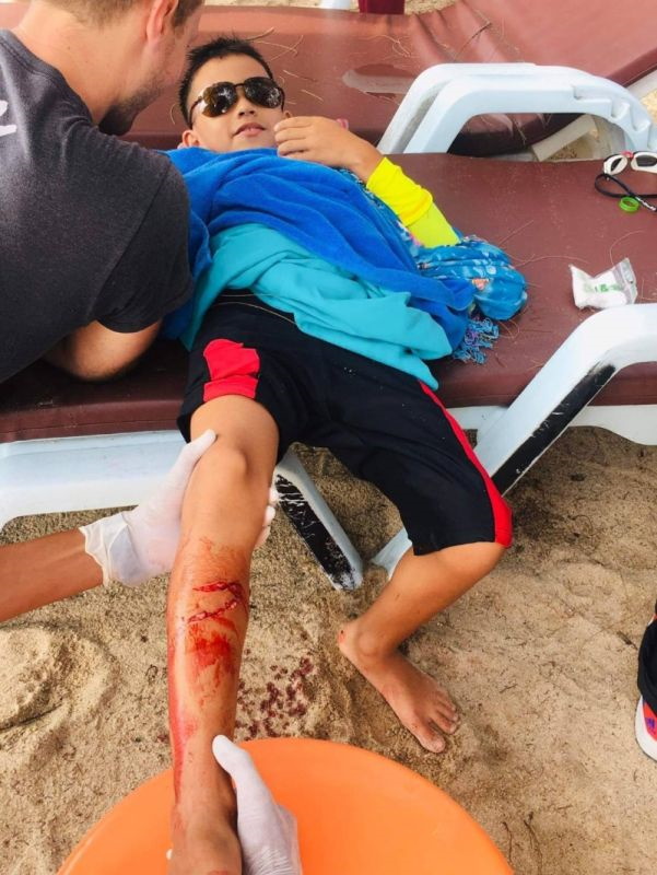 Акула укусила ребенка за ногу на пляже Пхукета. Фото: Служба спасения Камалы