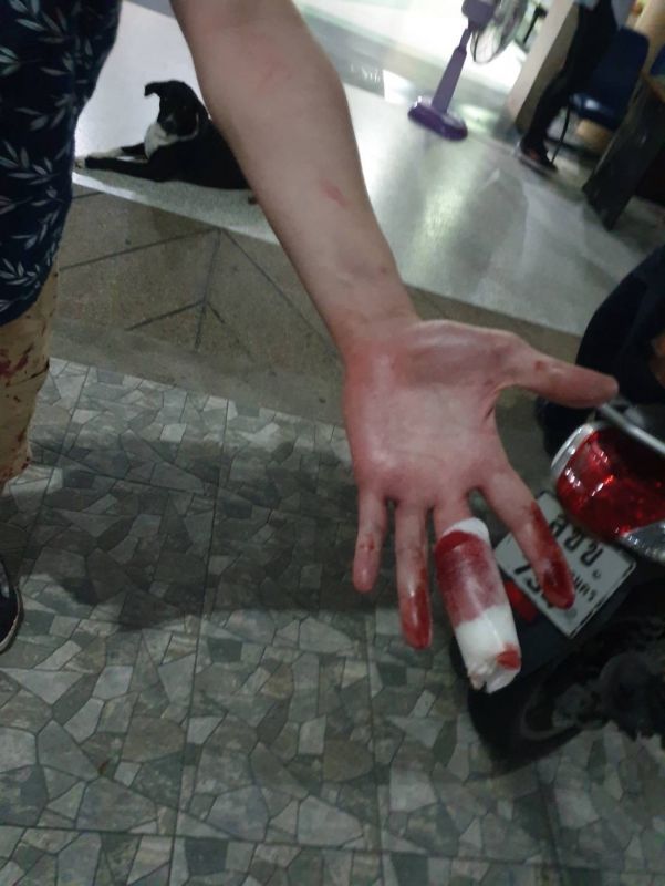 Травма руки, полученная Алгассимом. Фото: Иккапоп Тхонгтуб